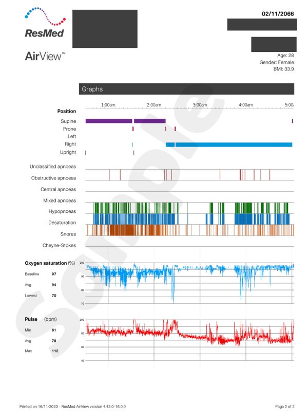 Sleep Test บริการสลีปเทส ทดสอบปัญหาการนอน อาการหยุดหายใจ กรน - Image 5