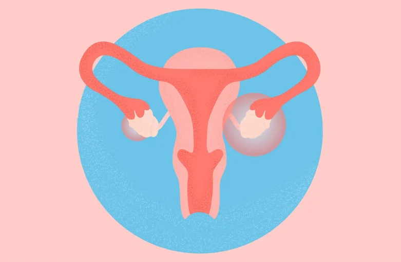 PCOS และ โรคเบาหวาน สองโรคที่ดูเหมือนไกล แต่ใกล้กันมากกว่าที่คิด