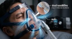 Read more about the article หน้ากาก CPAP รั่ว? เช็กตรงไหน พร้อมวิธีแก้ลมรั่วเข้าตา